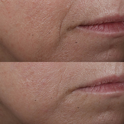 Сыворотка для лица Perricone Md Cold Plasma Plus Advanced Serum Concentrate 7.5 ml (без коробочки, из набора)