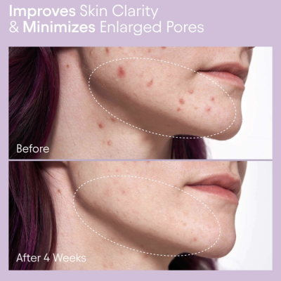 Отшелушивающий тоник с 2% BHA кислотой Alpyn Pore Perfecting Liquid 2% BHA & Borage 120 ml