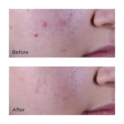 Крем для обличчя з саліциловою кислотою для шкіри, схильної до висипань Perricone MD Maximum Strength Clearing Treatment 59 ml