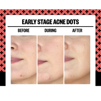 Точечные патчи от прыщей Peace Out Early Stage Acne Dots 8 шт