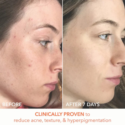 Пілінг для обличчя Dr. Dennis Gross Skincare Alpha Beta Universal Daily Peel