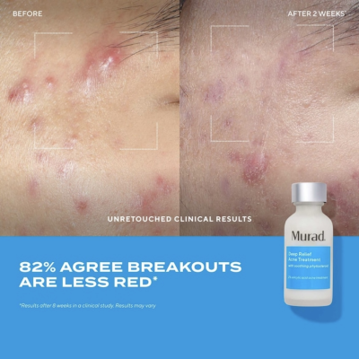 Сироватка від висипань для проблемної шкіри Murad Deep Relief Acne Treatment 30 ml