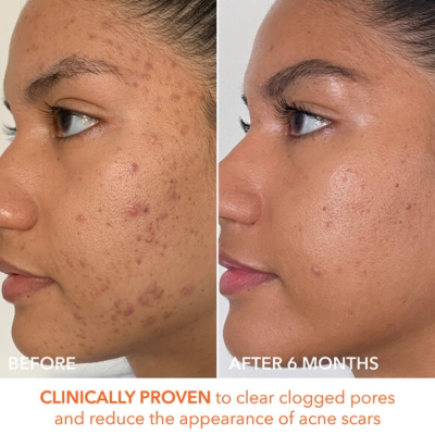 Кислотный пилинг Dr.Dennis Gross Alpha Beta Peel Extra Strength Formula (в наборе 3 пластины по 2 салфетки)